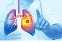 her yil 25 bin akciger kanseri vakasi onlenebilir