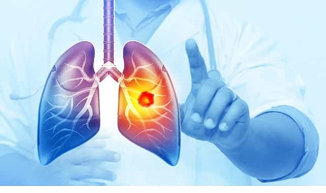 her yil 25 bin akciger kanseri vakasi onlenebilir